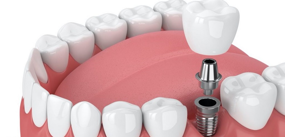 Stabilize your artificial teeth with Port Moody dental implants