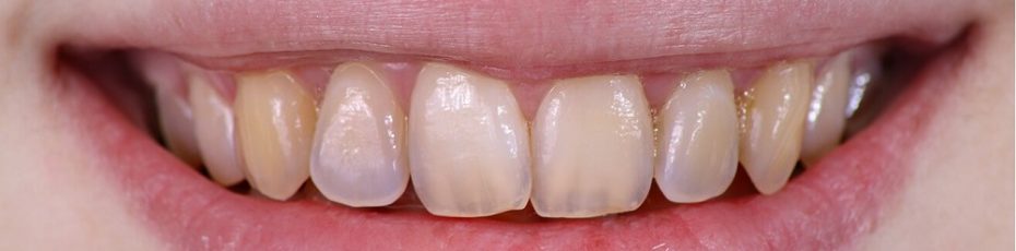 Everything You Need To Know About The Shield of Teeth – Enamel