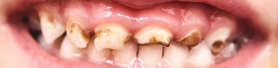 what sugar does to a child’s teeth