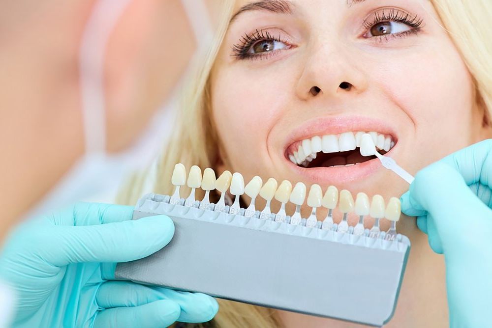 5 Reasons to Choose Professional Teeth Whitening