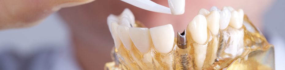 dental implants in Port Moody
