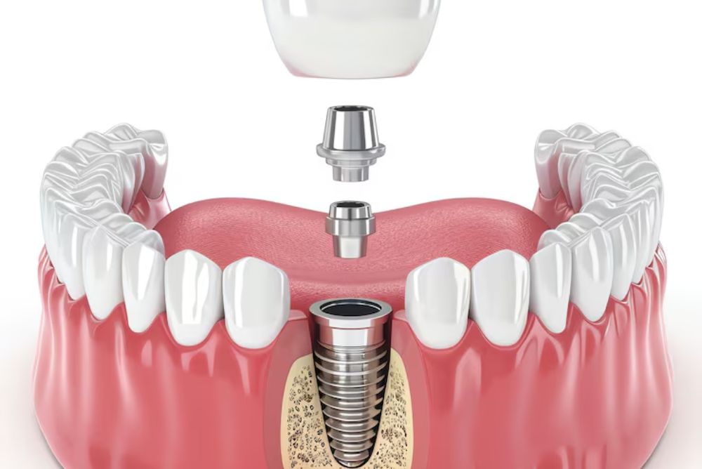 What are the benefits of Dental Implants