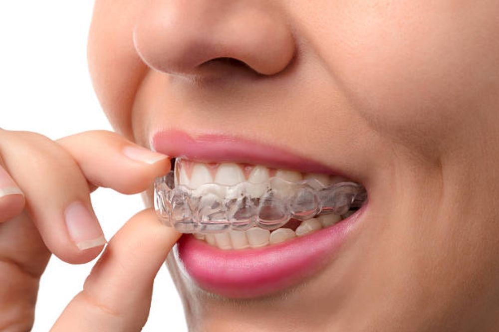 Invisalign in Port Moody