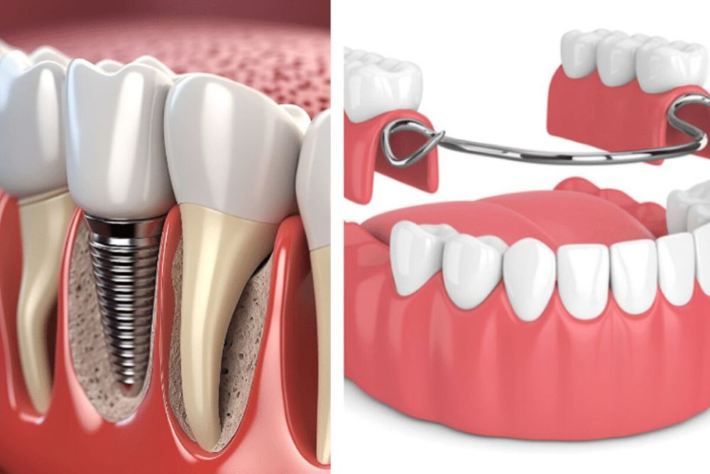 Implant Dentistry in Port Moody