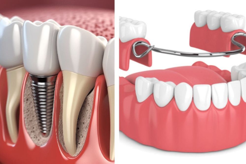 Dental Implants Vs. Dentures: Which Option Is Best For You