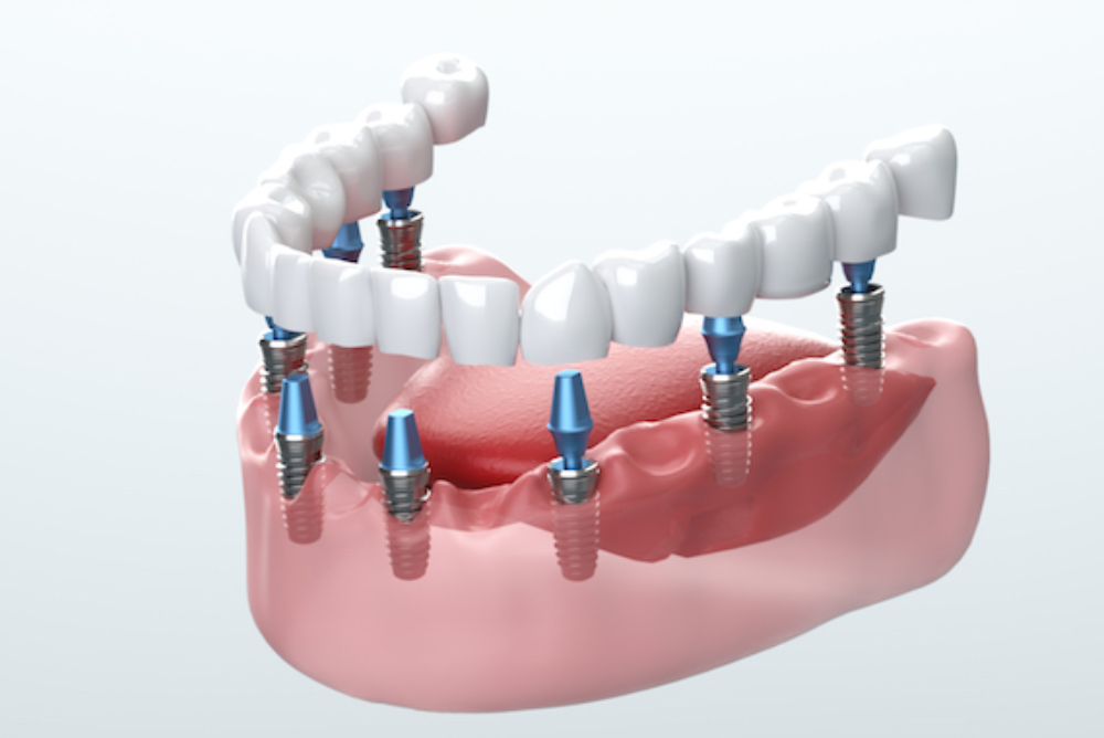 Implant Dentistry in Port Moody