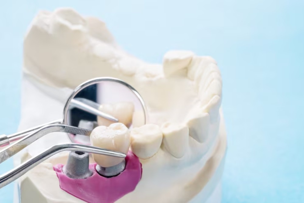 Can I Eat Normally with a Dental Bridge