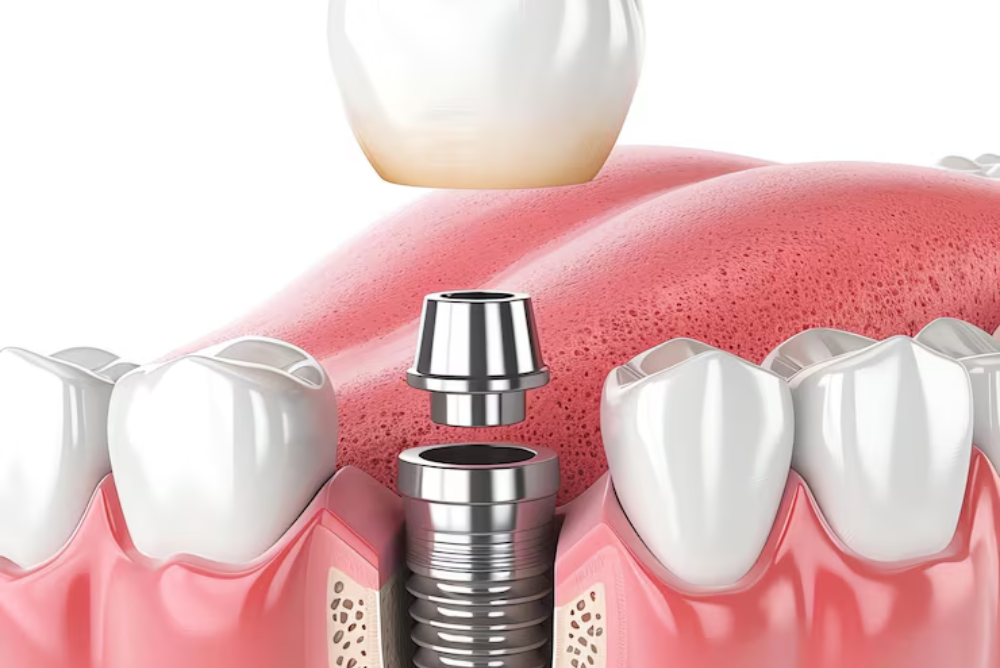 Replace Missing Teeth with Expert Implants